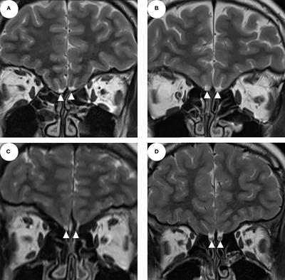 The diagnostic value of the olfactory evaluation for congenital hypogonadotropic hypogonadism